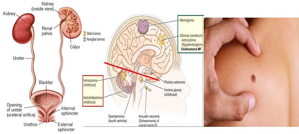 Diagnosis and Treatment of  Cancers II